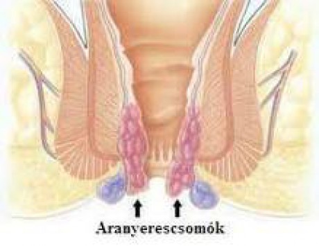 Aranyér