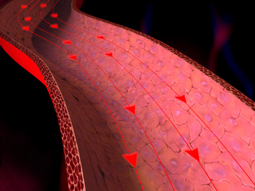 hypertension