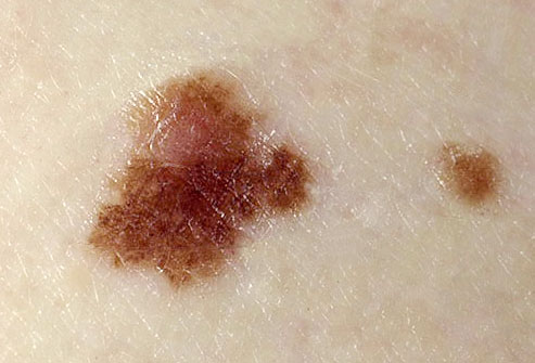 melanoma