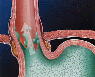 Reflux betegség
