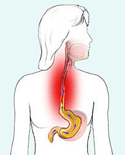 reflux betegség