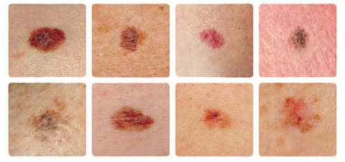 melanoma