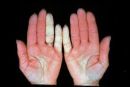 Raynaud kór