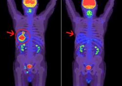 pet-ct-vastagbélrák