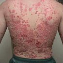 pikkelysömör - psoriasis