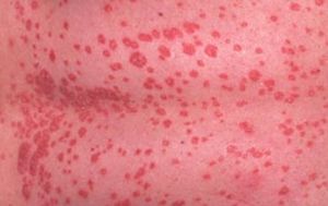 psoriasis