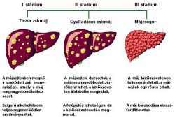 krónikus májbetegség