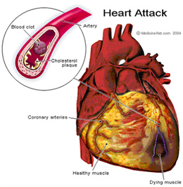 infarktus